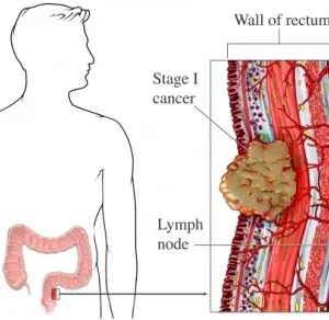 Sangre Oculta en Heces